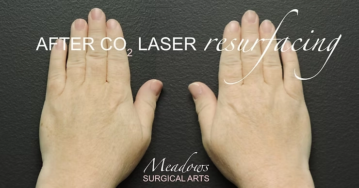 Hands, Resurfaced