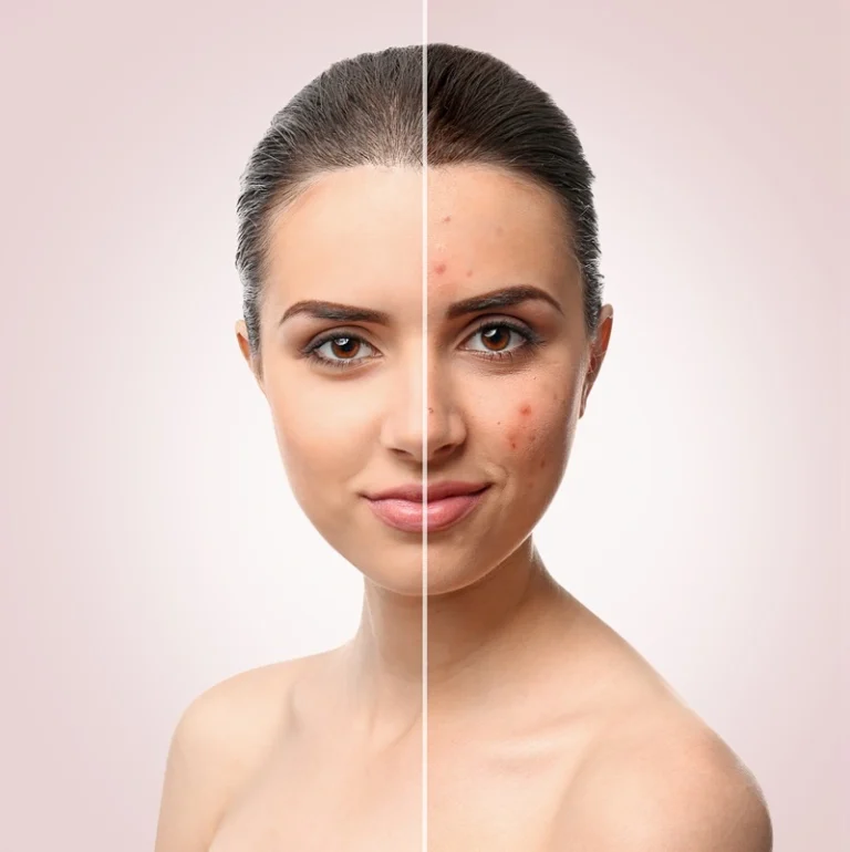 Laser brown spot removal