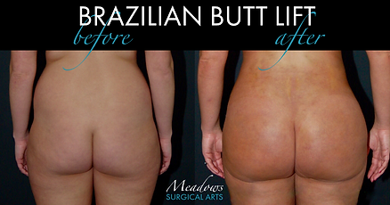 DO YOU HAVE LIPOSUCTION BEFORE AND AFTER PICTURES?