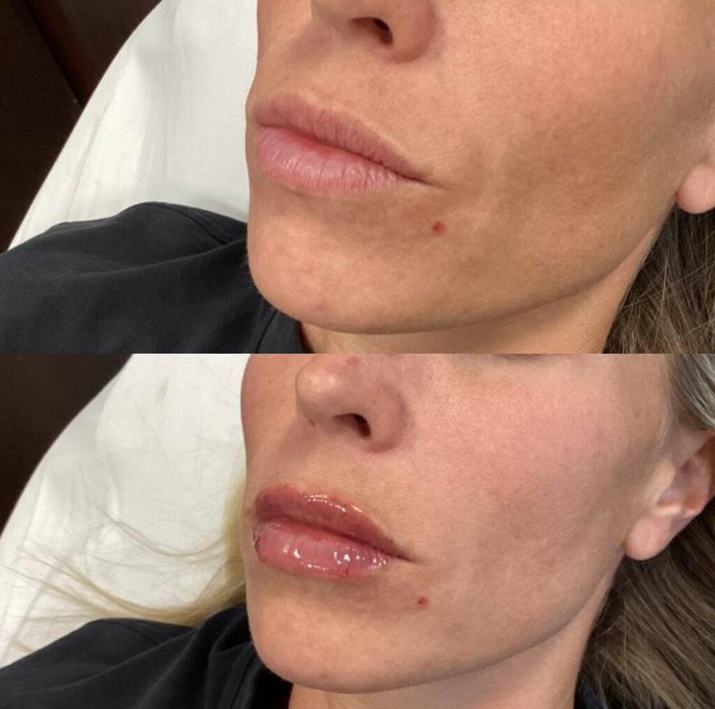 Lip Surgery at Aesthetic Arts in Georgia