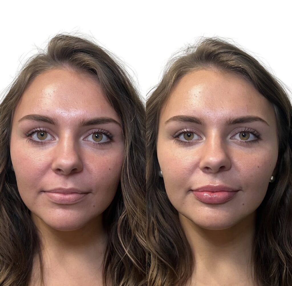 Lip Surgery at Aesthetic Arts in Georgia