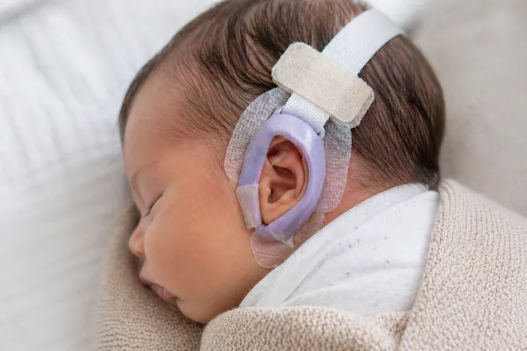 How Does Non-Surgical Ear Correction Work?