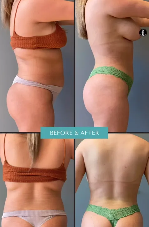 Can you combine liposuction with a tummy tuck for better results?