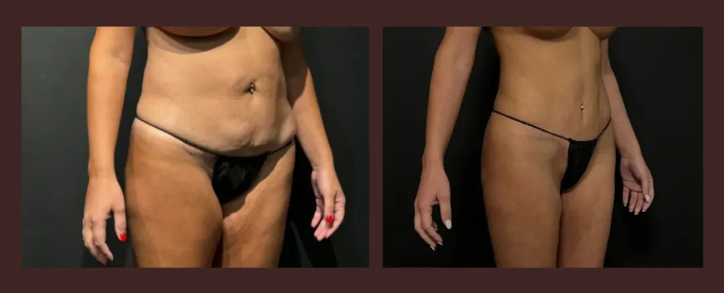 How do you decide which tummy tuck is right for you?