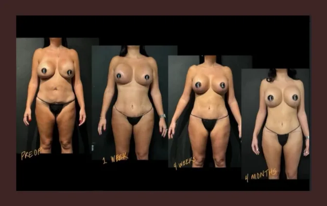 What are the detailed steps of the tummy tuck procedure?