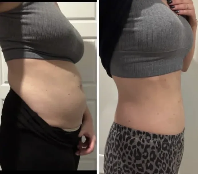What does tummy tuck recovery look like week by week?