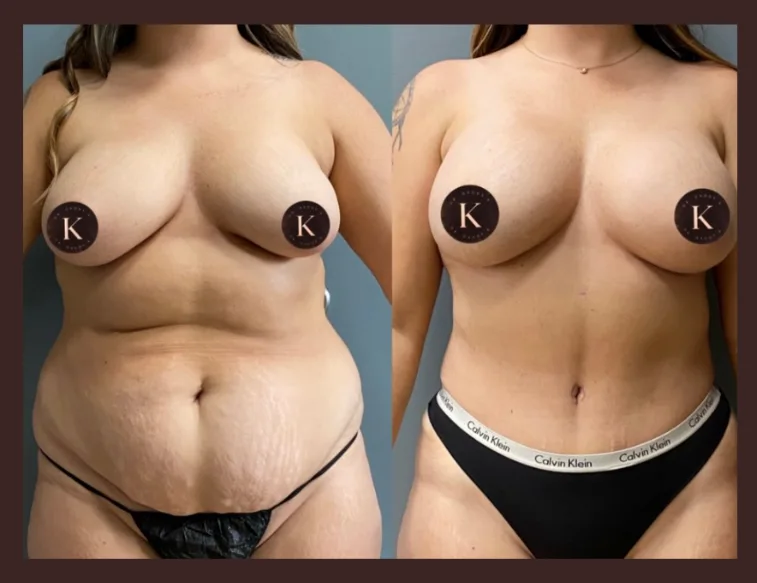 What happens immediately after tummy tuck surgery?