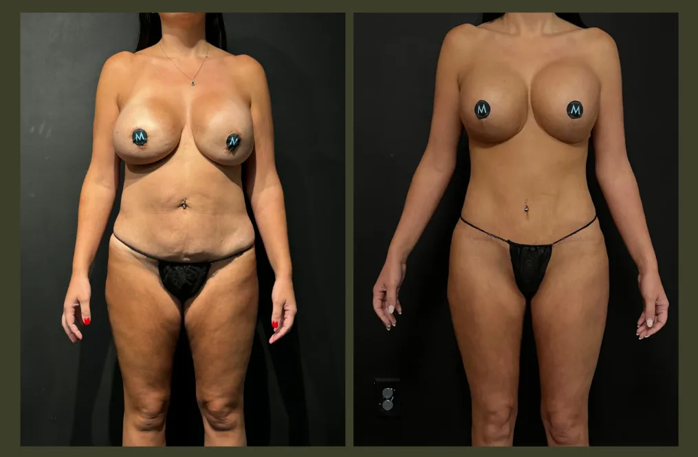 What types of tummy tucks are available?