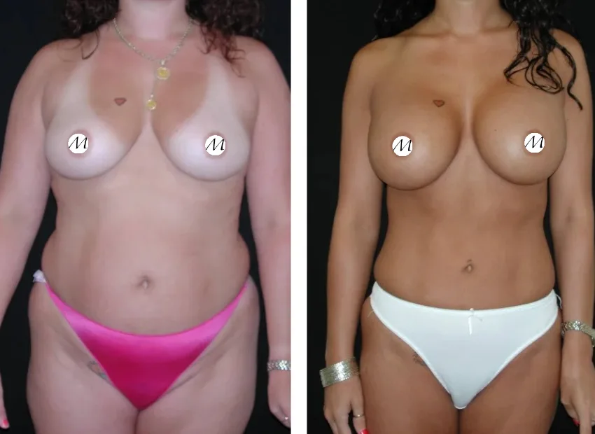 How does the stomach liposuction procedure work?