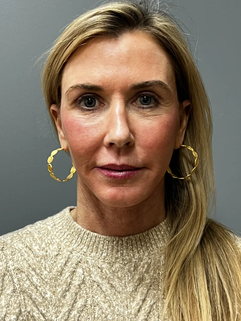 After deep plane face and neck lift, front view, Case 101