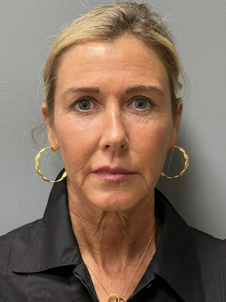Before deep plane face and neck lift, front view, Case 101